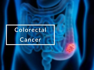 COLORECTAL CANCER